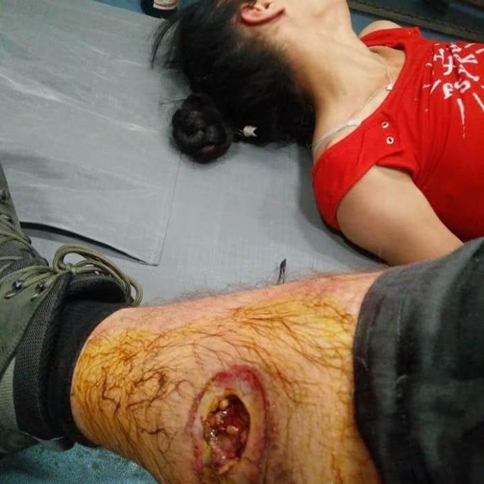 Tănăr rănit: Jandarmeria română a folosit grenade cu ȘRAPNEL. Mulțumesc din suflet MILIȚIEI române