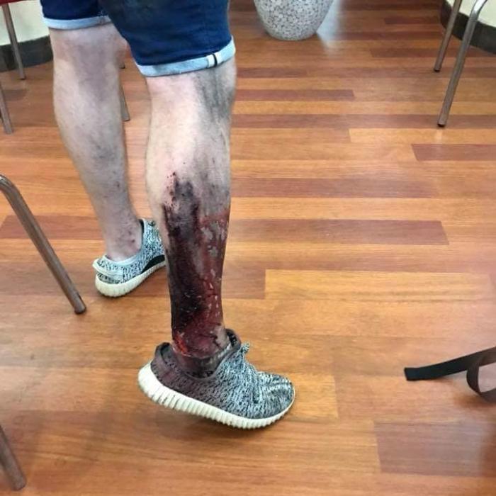 Român RĂNIT pe 10 august vrea REDESCHIDEREA Secției de Arși. Acolo a fost îngrijit