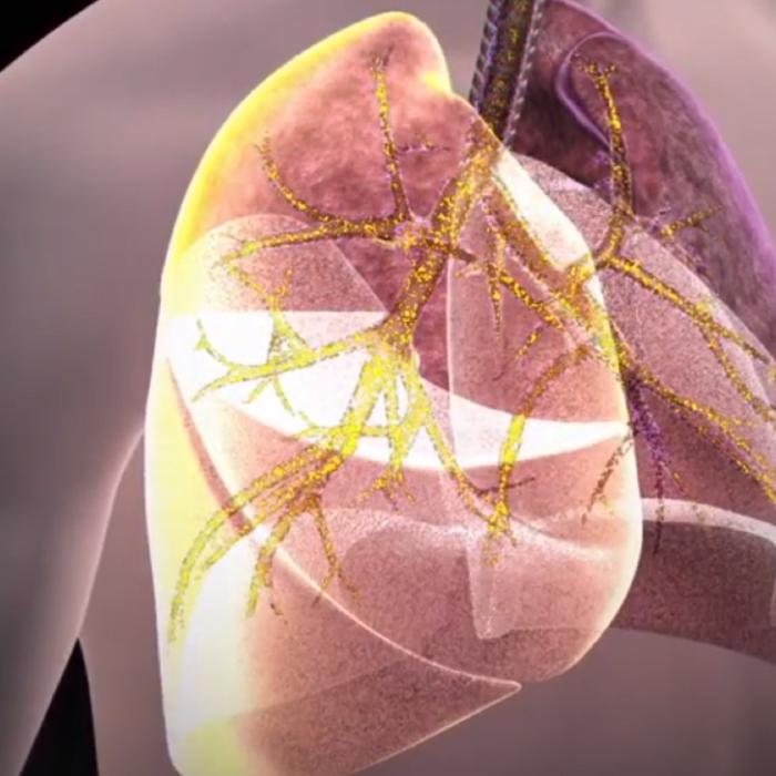 Avertisment. O nouă pneumonie a ucis peste 1.700 de oameni. Este mai mortală decât Covid-19