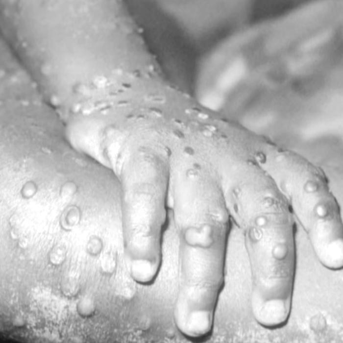 Primul copil infectat cu variola maimuței. Mister total cum s-a putut infecta băiatul de doar 9 ani 