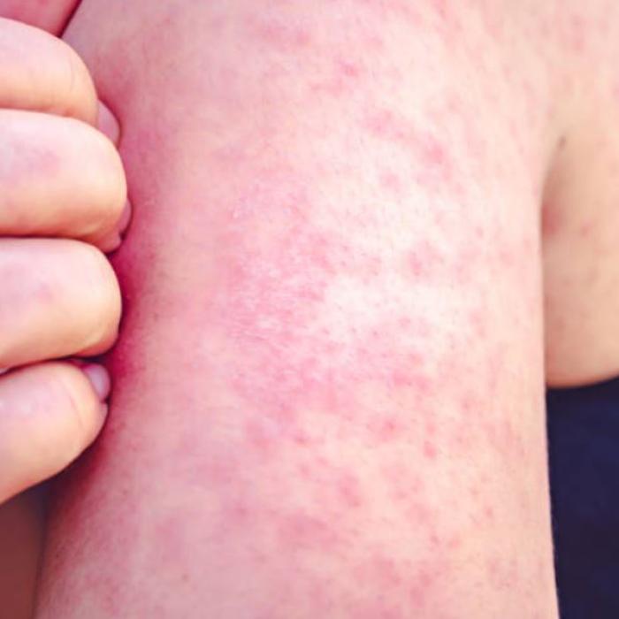 Cazurile de rujeolă explodează în Mare Britanie, din cauza scăderii vaccinărilor. Medicii, în alertă: "Creșterea este foarte îngrijorătoare“