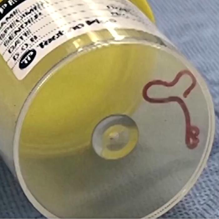 Un vierme viu, de opt centimetri, extras de medici din creierul unei femei: Parazitul ar fi ajuns acolo când femeia culegea spanac