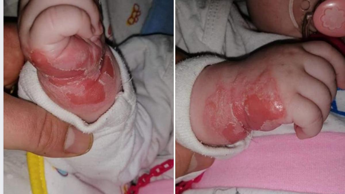 bebelus_alergie_branula_spital