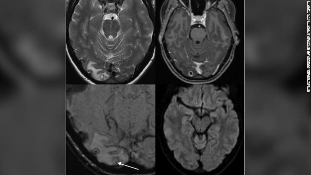 australia_tapeworm_headache_brain_