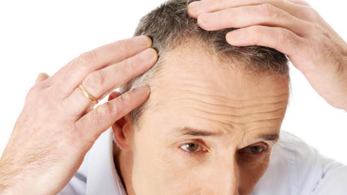 barbat-chelie-par-transplant-flickr