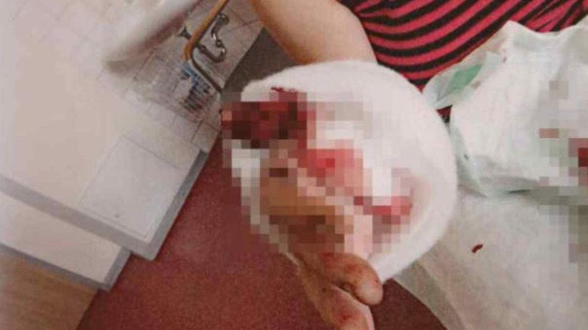 germania--o-romanca-a-ramas-fara-un-deget--dupa-ce-a-fost-muscata-de-un-conational