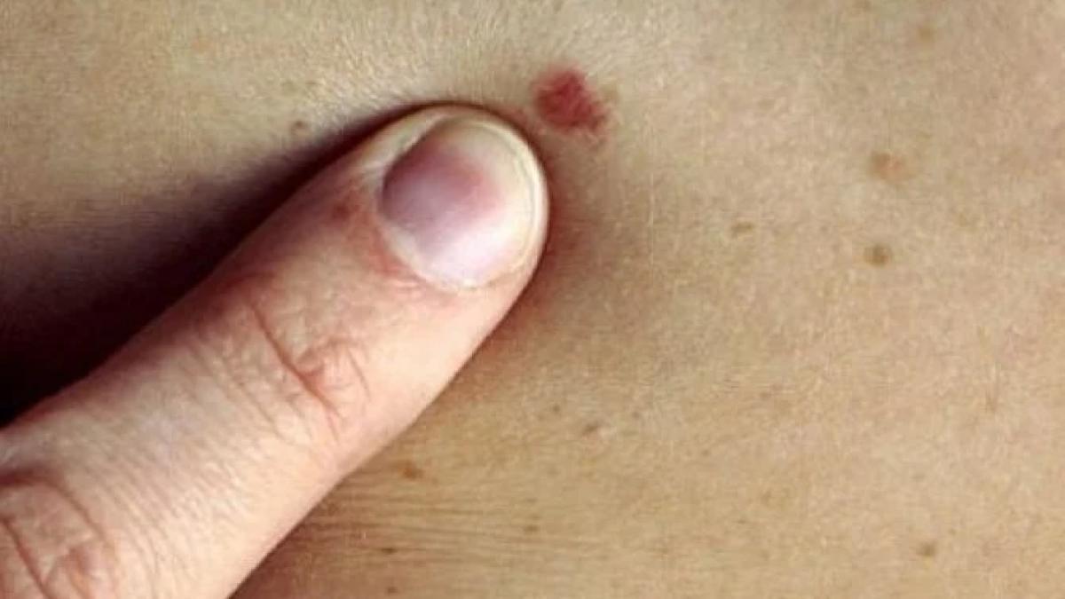 cancer_piele_29942600