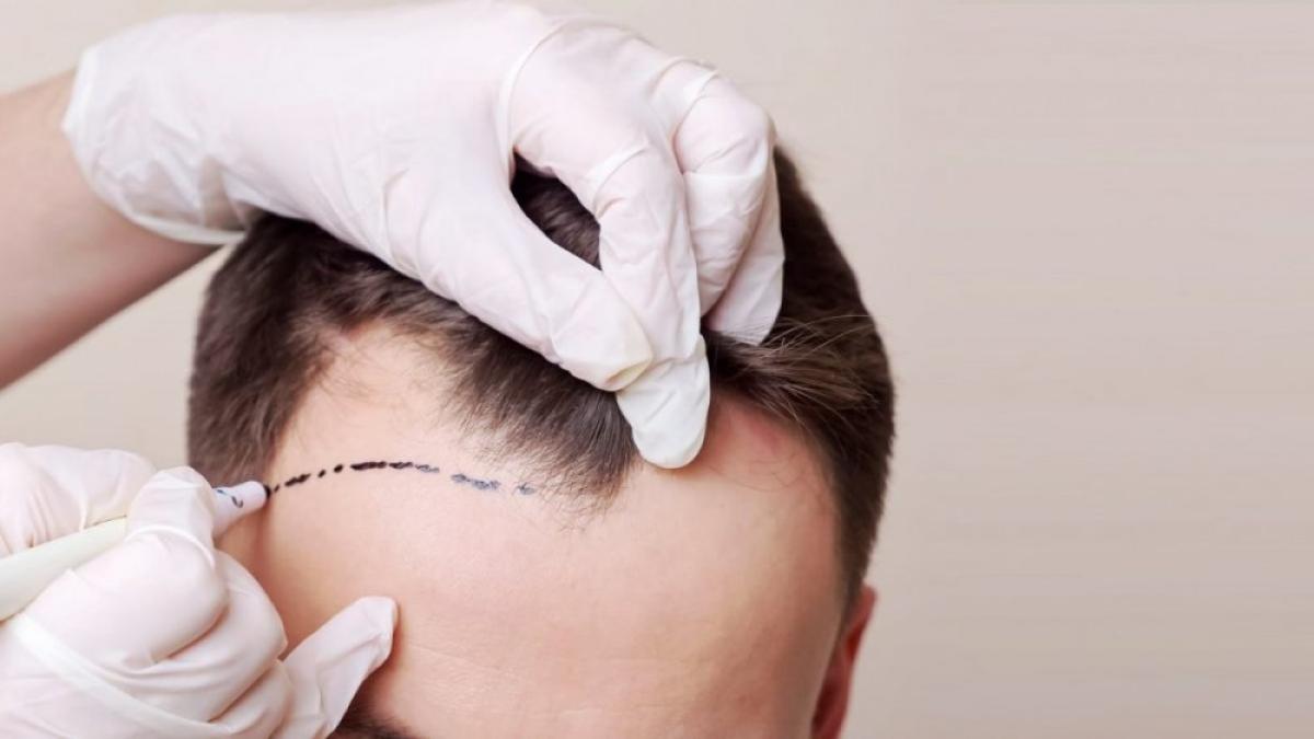 implant-de-par_4_23608300