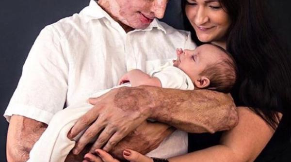 Marea Britanie. ROMÂNUL desfigurat cu acid de fosta logodnică s-a CĂSĂTORIT : „Unii au fost ȘOCAȚI” 