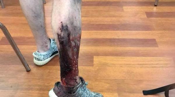 Român RĂNIT pe 10 august vrea REDESCHIDEREA Secției de Arși. Acolo a fost îngrijit