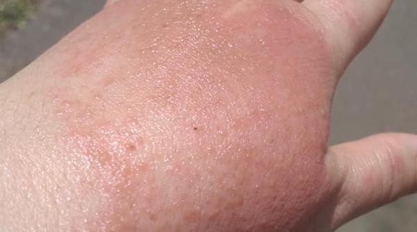 O româncă s-a ales cu mâinile UMFLATE după ce a folosit dezinfectantul dintr-un supermarket: "Mă ustură de mor! Zici ca-s fiartă în oală!"