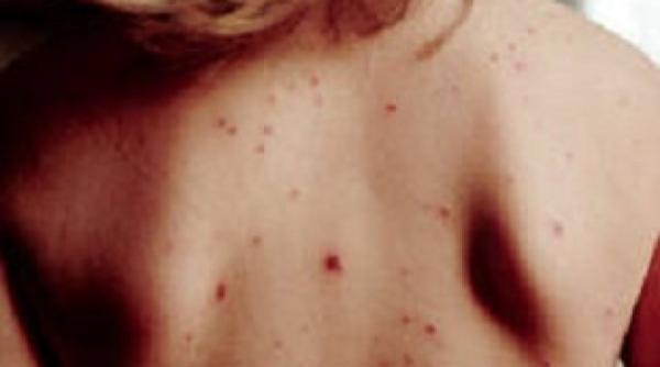 Un virus contagios a provocat mai multe victime în România. Nu este COVID-19. Mai multe cazuri, confirmate