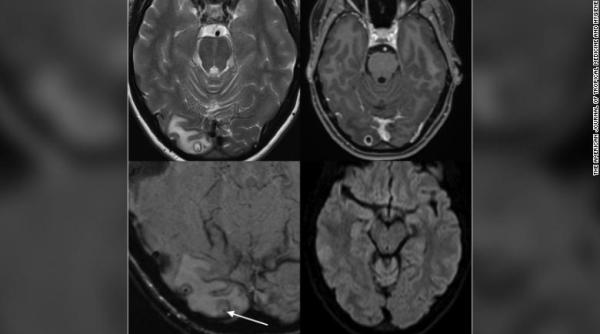Caz demn de Dr. House: Suferea de migrene groaznice. La RMN s-a văzut că avea VIERMI în CREIER