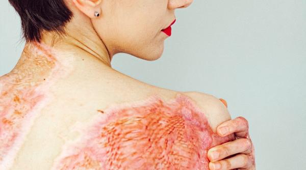 Supraviețuitoare a incendiului din Colectiv, apel către români: „Puneți-vă mască, mergeți și arătați-le că nu suntem ai lor, ci ai noștri”