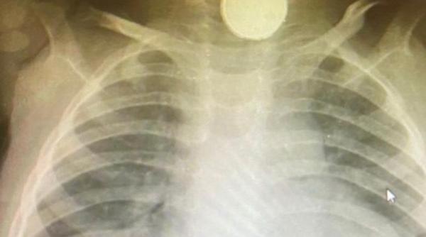 Un copil din Marea Britanie a stat patru luni cu o baterie blocată în gât