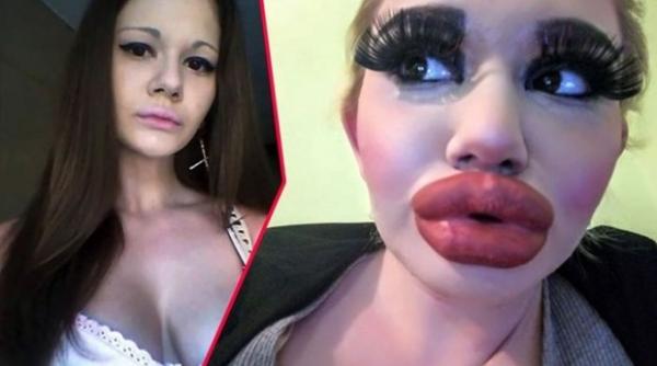 Andreea vrea să intre în „Cartea Recordurilor”. Tânăra are cele mai mari buze din lume