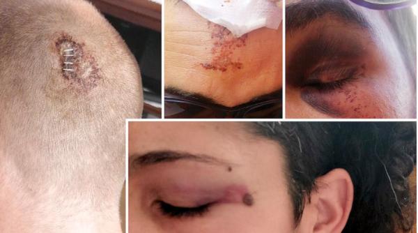 Spania. Trei români, căutați după o bătaie cruntă. Victimele au ajuns la spital inconștiente, cu răni grave