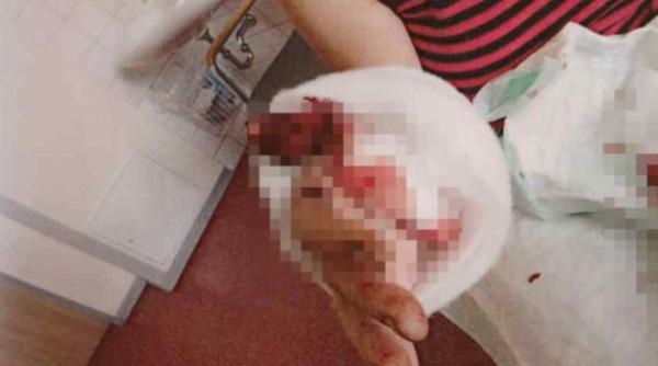 Germania. O româncă a rămas fără un deget, după ce a fost mușcată de un conațional 