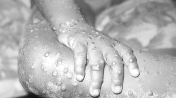 Variola Maimuței. Ce este, simptome și cum se răspândește această boală: Ministerul Sănătății, precizări despre epidemie