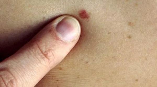 Tratament inovator pentru cancerul de piele