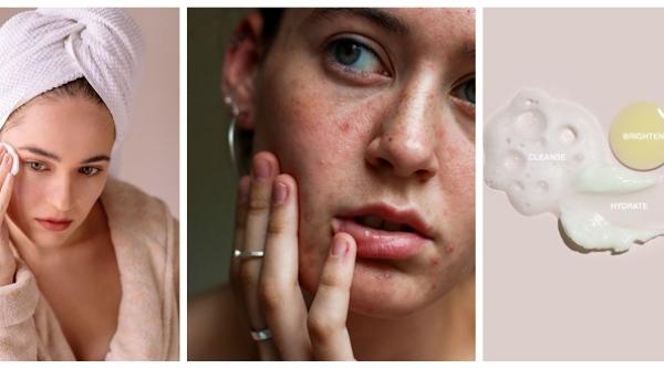 Cum să curățați tenul problematic: sfatul experților