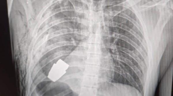 Un chirurg neînfricat a îndepărtat o grenadă care putea exploda, din corpul unui soldat ucrainean