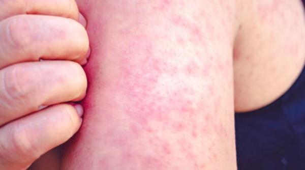 Cazurile de rujeolă explodează în Mare Britanie, din cauza scăderii vaccinărilor. Medicii, în alertă: "Creșterea este foarte îngrijorătoare“