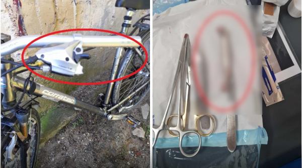 Românul cu frâna de bicicletă cusută în picior a aflat abia în Olanda ce i-a făcut medicul din Urlați