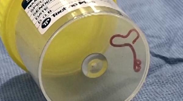 Un vierme viu, de opt centimetri, extras de medici din creierul unei femei: Parazitul ar fi ajuns acolo când femeia culegea spanac