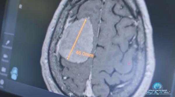 Tumoră cerebrală de mari dimensiuni, operată cu succes de medicii de la Spitalul "Prof. Dr. Nicolae Oblu" din Iaşi