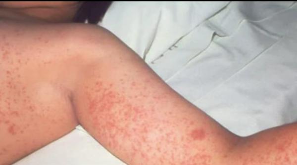 Un copil român cu pojar a transmis boala mai multor pasageri în avionul care a plecat din Londra