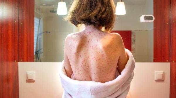 SUA: primul deces de la rujeolă