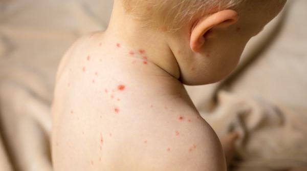 Alertă în Italia: Cresc cazurile de rujeolă. Medicii arată cu degetul spre antivacciniști și știri false: "Vitamina A nu previne rujeola"