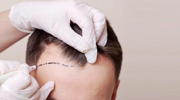 Ești interesat de prețul pentru implant de păr? Află de aici detalii surprinzătoare 