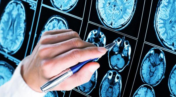 Rezultatul a 20 de ani de teste: ”Compusul 10”, molecula care stopează degradarea neuronilor și oprește boala Alzheimer